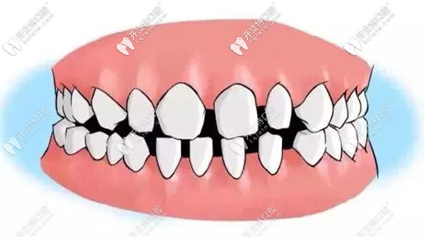 30歲牙齒稀疏門牙縫大怎么辦，做牙齒貼面or帶牙套矯正好