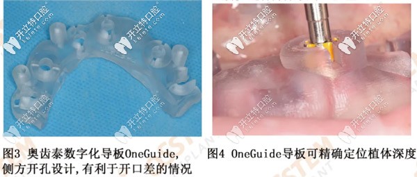 奧齒泰數(shù)字化導(dǎo)板