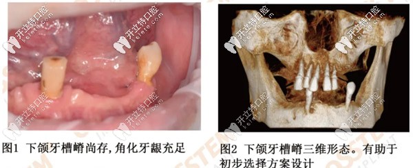下頜無牙者利用奧齒泰轉(zhuǎn)換基臺完成了數(shù)字化導(dǎo)板即刻修復(fù)