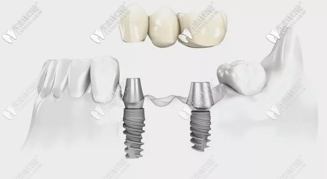 種植牙結(jié)構(gòu)示意圖