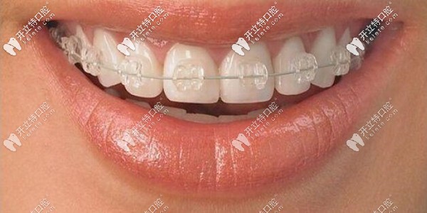 岳陽(yáng)市半隱形矯正多少錢