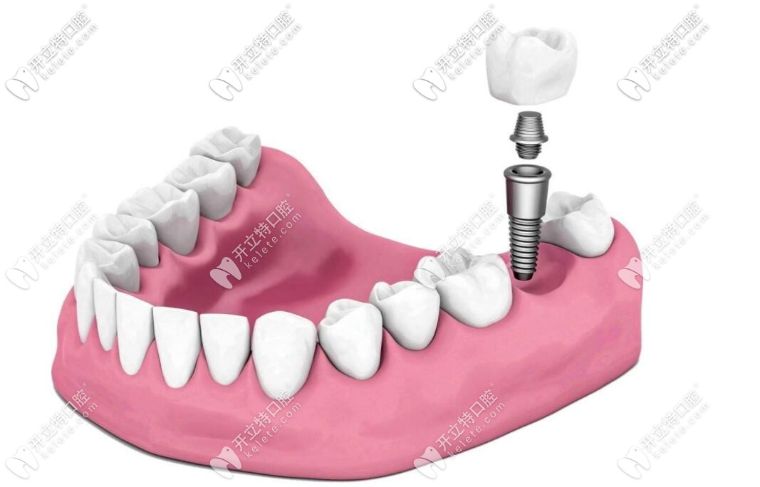 種植牙 種植牙