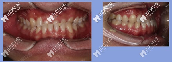患者牙齒矯正前