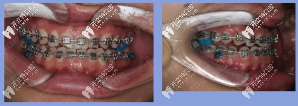 患者地包天牙齒矯正中