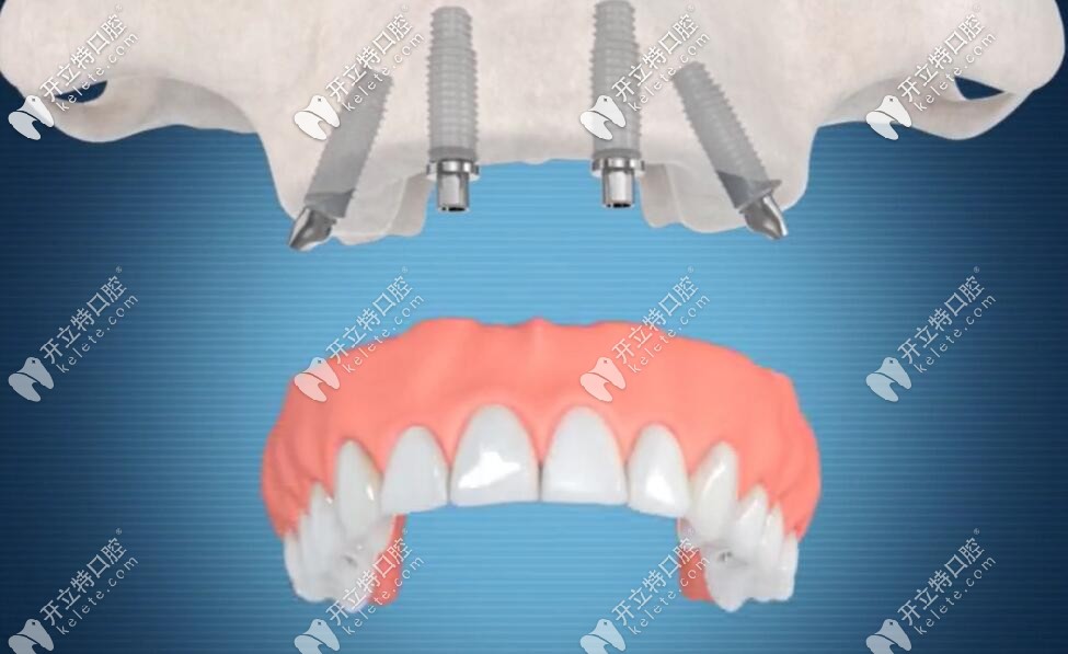 植入植體后戴牙冠過程