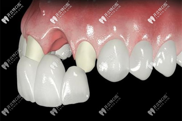 牙齒做全瓷牙過程示意圖