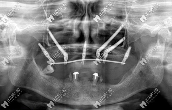 穿顴穿翼種植體在面部骨骼的分布圖