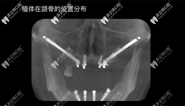 種植體在頜骨的位置分布圖