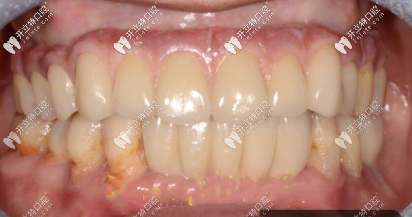 老媽做的上半口種植牙效果圖