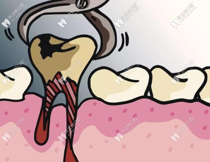 拔牙創(chuàng)口是不是比種牙大