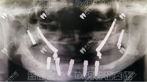 廣州暨大穗華馮智強(qiáng)博士又成功完成1例穿顴穿翼種植牙案例