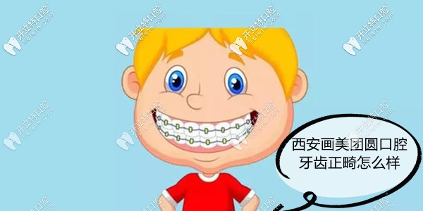 西安團(tuán)圓口腔矯正牙齒怎么樣?團(tuán)圓口腔正畸技術(shù)好價(jià)格不貴