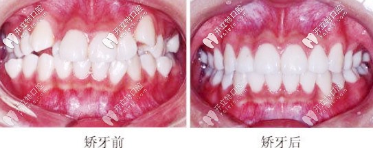 矯正牙齒前后對比圖