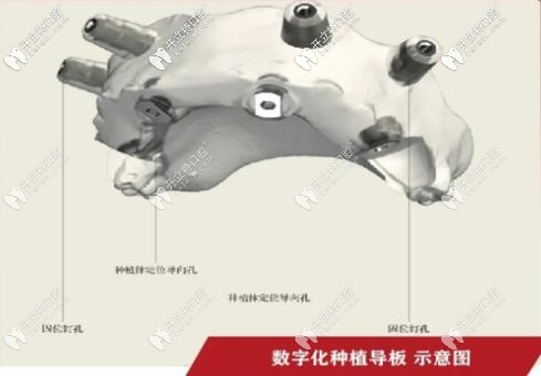 好大夫口腔：數(shù)字導(dǎo)板引導(dǎo)種植技術(shù)——告別傳統(tǒng)“盲種”