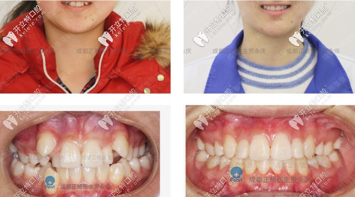 矯正前后對比圖