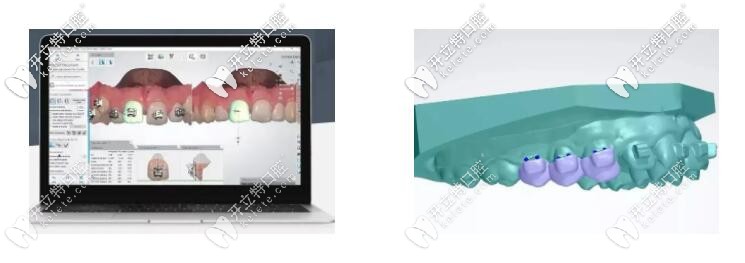 藍天口腔的智能正畸粘接導(dǎo)板技術(shù)