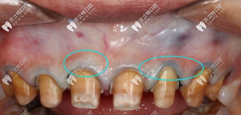 使用Procera全瓷牙修復(fù)不會出現(xiàn)以下這種情況