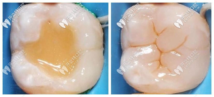 補(bǔ)牙材質(zhì)與真牙無差