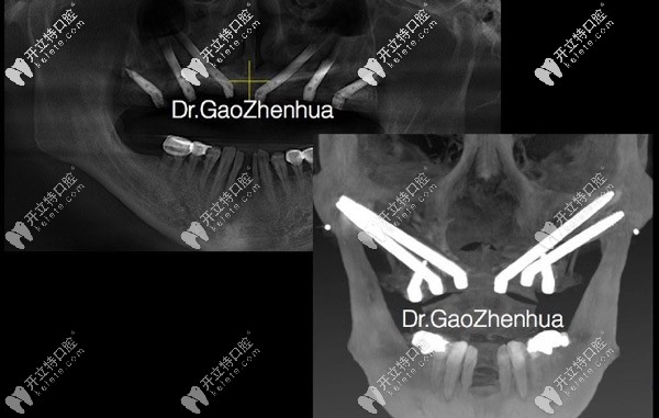 極端缺骨條件下的穿顴穿翼即刻負重