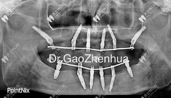 滿口即刻負重種植技術(shù)