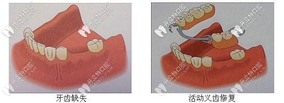 活動假牙修復示意圖