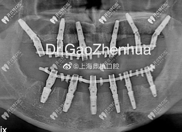 全口即刻負重即刻修復(fù)