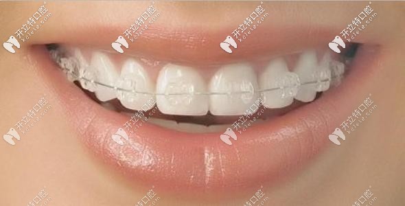 這是陶瓷牙套的外觀哦