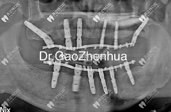 上頜VIIV、下頜6顆即刻種植方案