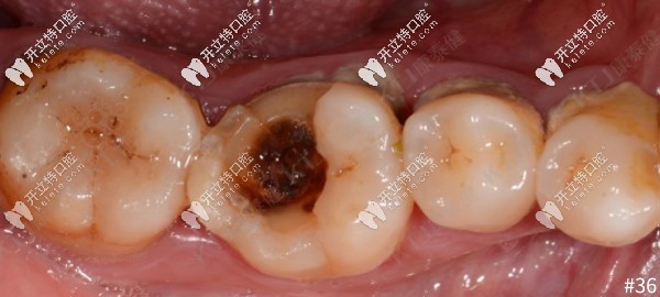 牙齒大面積缺損，用康泰健格萊美瓷嵌體修復(fù)案例分享