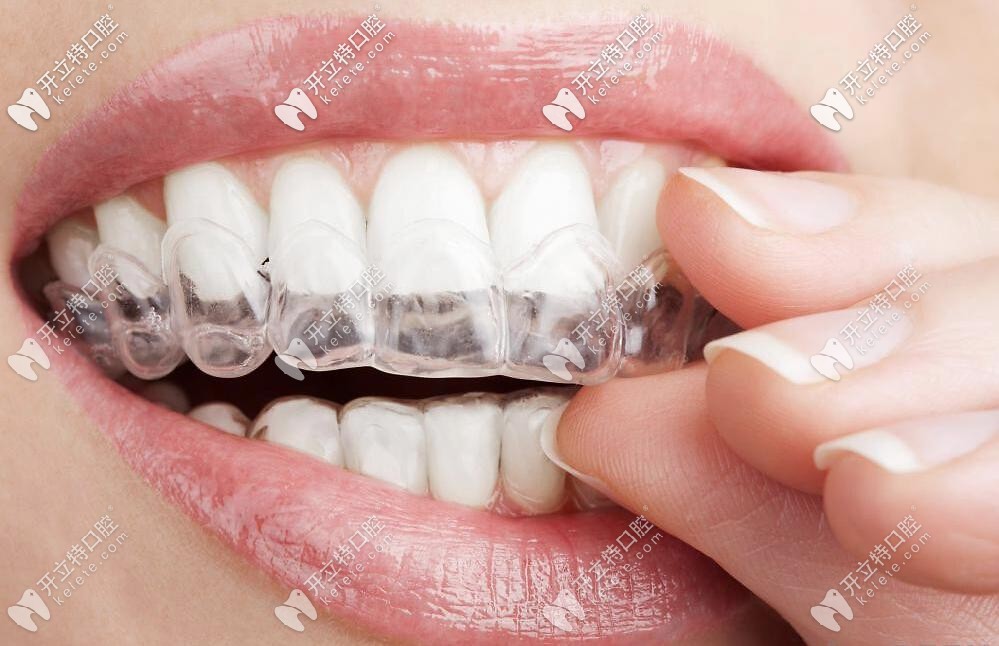 隱形牙套圖示 隱形牙套圖示