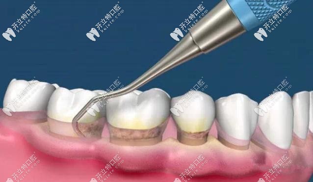 齦下刮治示意圖 齦下刮治示意圖