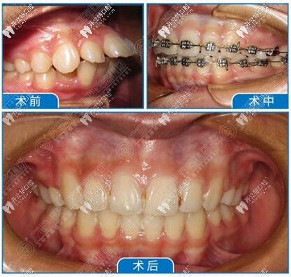 玉林藍天口腔醫(yī)院正畸效果好嗎?總店牙齒矯正收費標準是