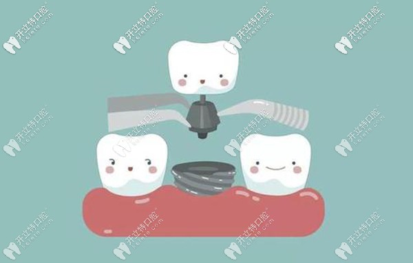 中諾口腔種植牙時間快