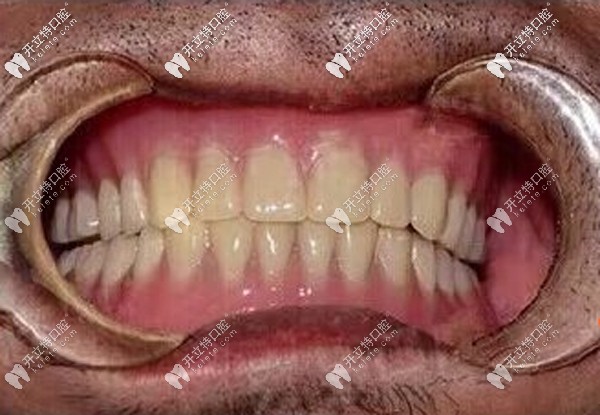 70歲無牙老人做全口種植牙真實(shí)感受：立得用種植牙技術(shù)靠譜