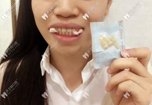 矯正前拔牙后的樣子