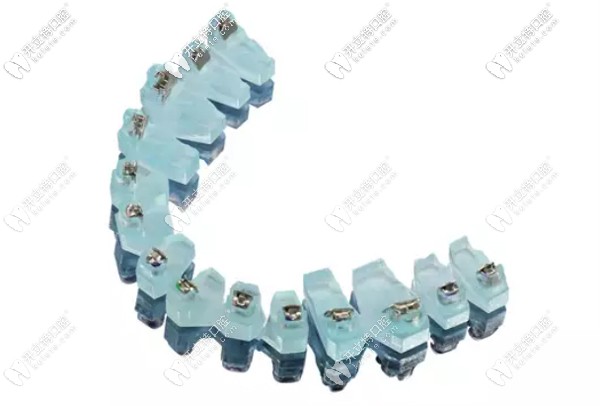 奧世美數(shù)字化金屬自鎖牙套的價(jià)格、優(yōu)勢及矯正效果解析~