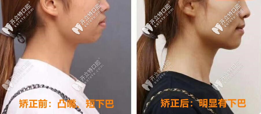 矯正前后對(duì)比照片：明顯有下巴，側(cè)顏好看