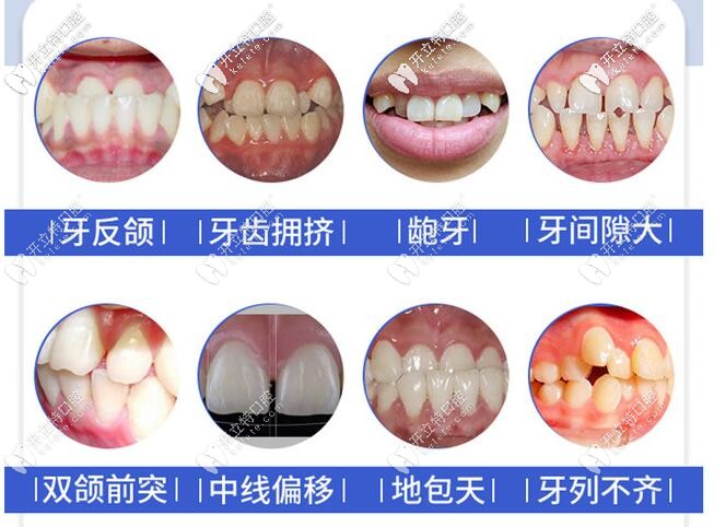 想知道重慶時代天使矯正價格嗎？世紀(jì)美奧口腔活動價19800