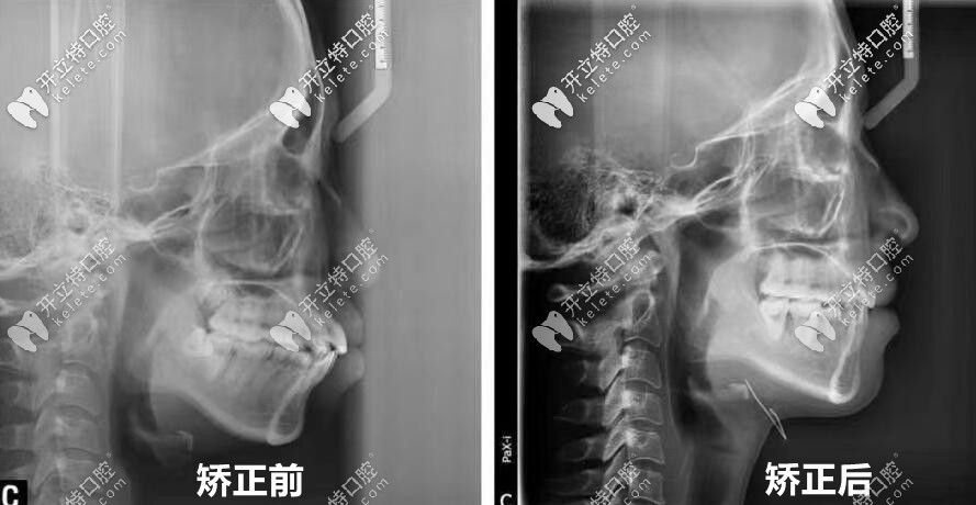 00后妹子：正畸前后全牙和頭顱側(cè)位片對(duì)比