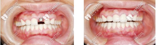 該院的種植牙案例