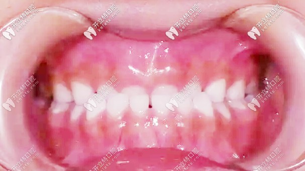 初次復(fù)診牙齒矯正無變化