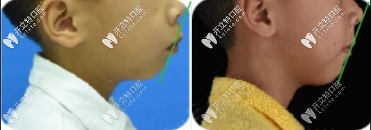 劉醫(yī)生案例：7歲孩子齙牙早期牙齒矯正