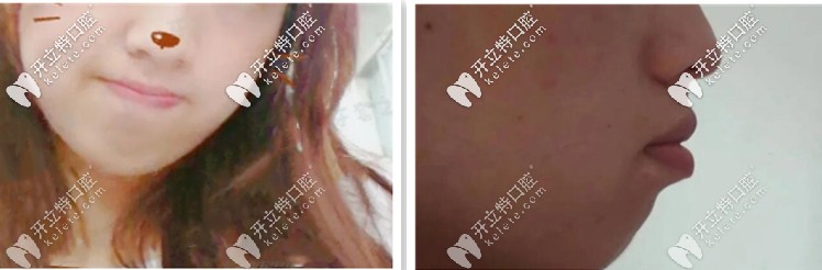 抿嘴的時候看起來就特別突兀，側(cè)顏突出