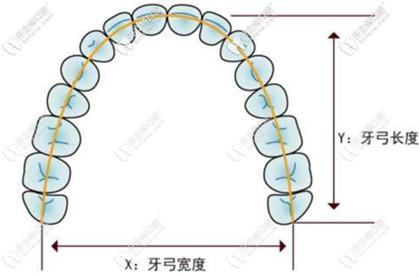 8-14歲的兒童使用牙齒擴弓的費用大概是多少？