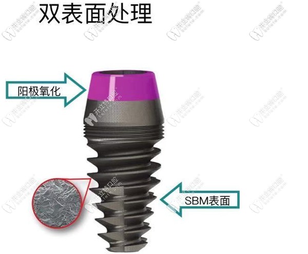 美國艾迪AIDI種植牙怎么樣，從aidi植體特點及價格來看