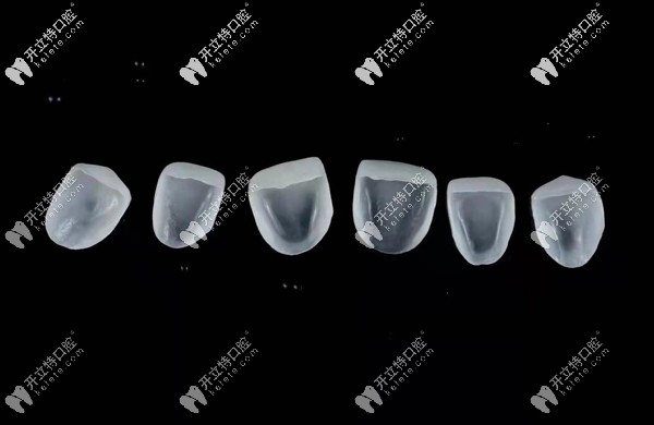 什么是美加超薄全瓷牙貼面