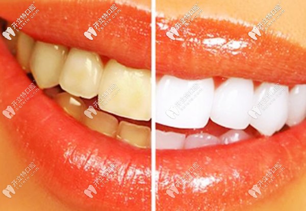 廣州市的牙齒修復(fù)價格