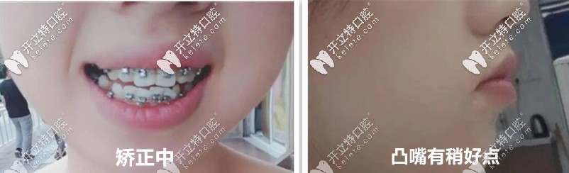 后來慢慢的開始有變化了，牙齒感覺在內(nèi)收了