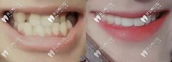 黃醫(yī)生：地包天、反頜復雜案例矯正