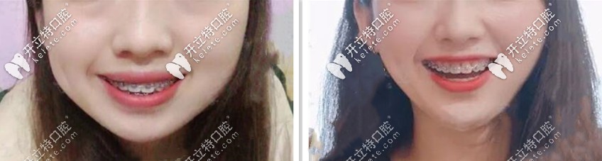 這時笑起來都不會覺得凸了，想不想初戀臉，哈哈哈哈